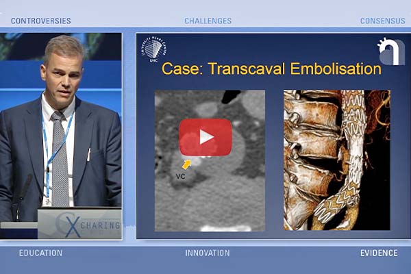 Discussion the various approaches to correcting endoleak during CX Symposium